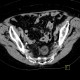 Fibrolipoma in pelvis: CT - Computed tomography